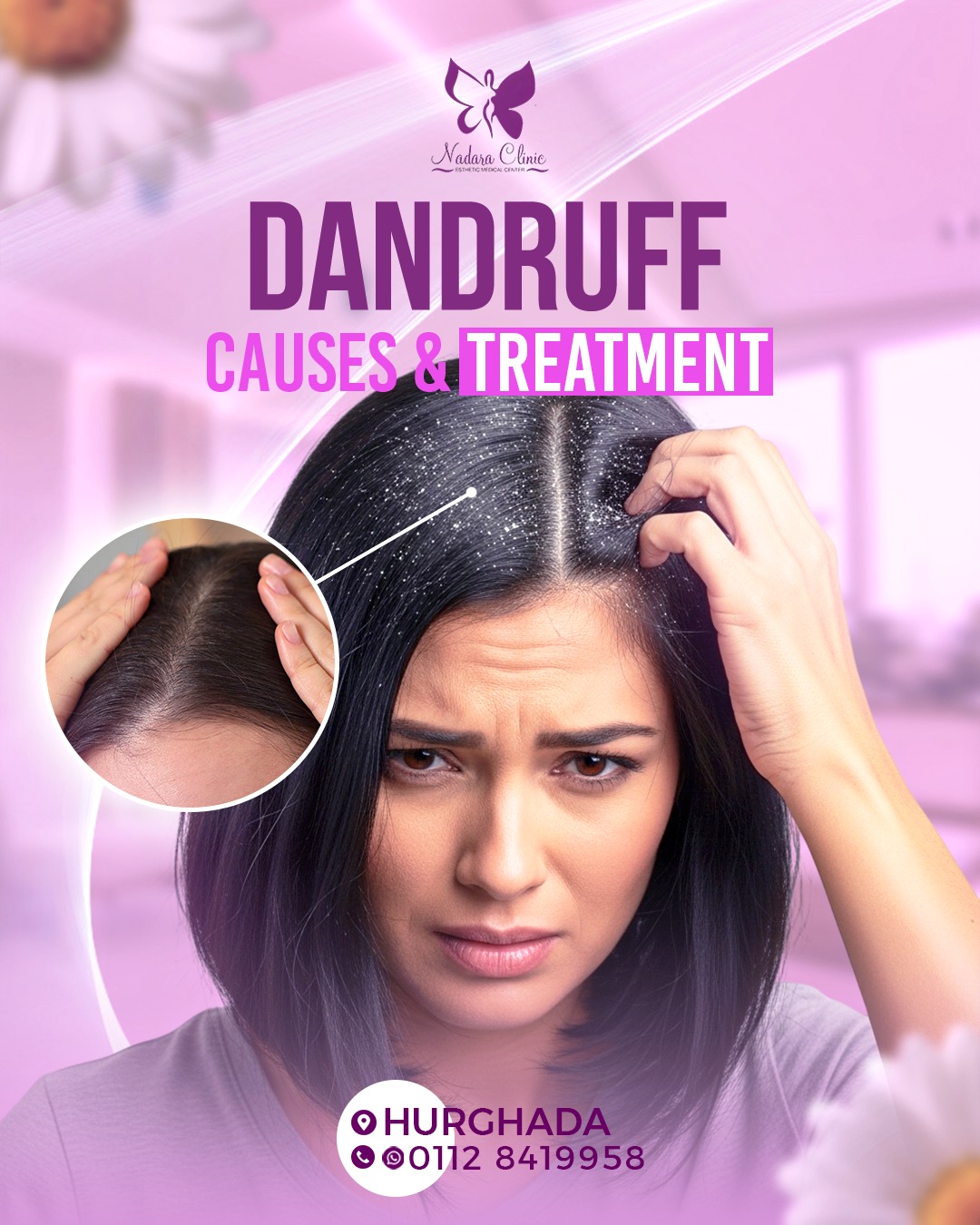 Dandruff: its causes and how to get rid of it in Hurghada